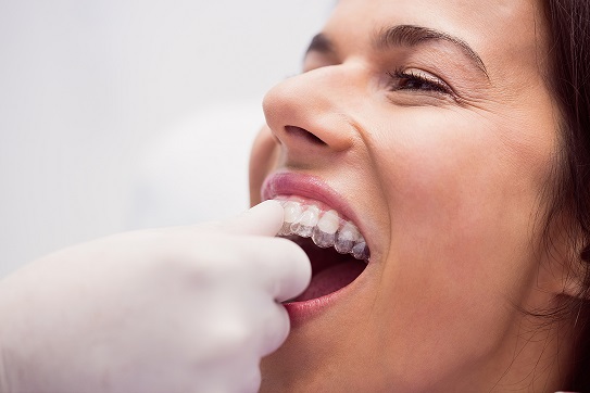 clear aligners treatment progress 
